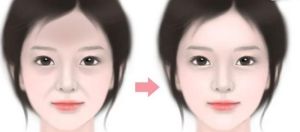 貴族手術 貴族手術