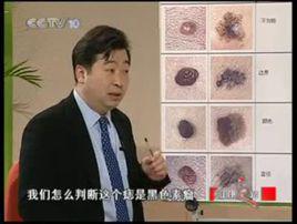 黑色素痣 黑色素痣