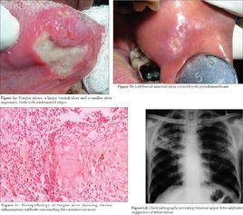 結核性潰瘍 結核性潰瘍