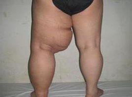 淋巴發育不全 淋巴發育不全