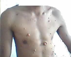 多發性神經纖維瘤 多發性神經纖維瘤