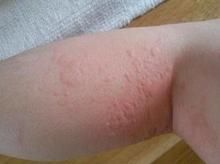 季節性濕疹 季節性濕疹