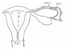 輸卵管狹窄形成輸卵管妊娠