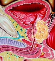 泌尿腫瘤解剖圖