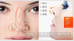 隱形膠原線隆鼻精確到鼻部各個亞單位
