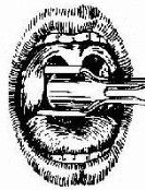 扁桃體切除術 扁桃體切除術