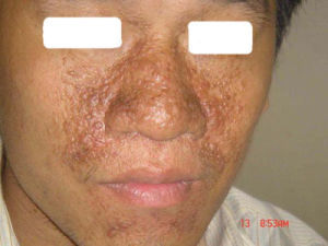 皮脂腺瘤 皮脂腺瘤