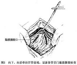 賁門黏膜撕裂綜合徵