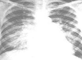 肺門陰影增多 肺門陰影增多