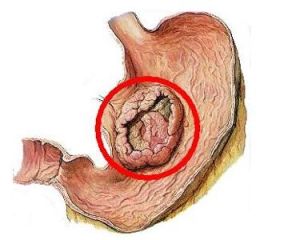 低分化胃癌 低分化胃癌