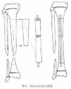 先天性脛骨假關節