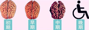腦萎縮發展變化