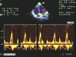 頻譜都卜勒超聲心動圖 頻譜都卜勒超聲心動圖