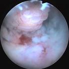 子宮頸內膜 子宮頸內膜