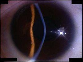 角膜糜爛 角膜糜爛