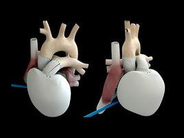 人工器官 人工器官
