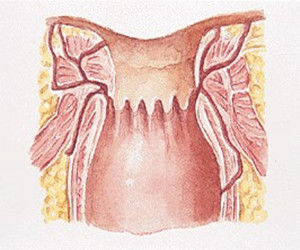 結核性肛瘺 結核性肛瘺