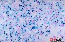 特發性含鐵血黃素沉著症 特發性含鐵血黃素沉著症