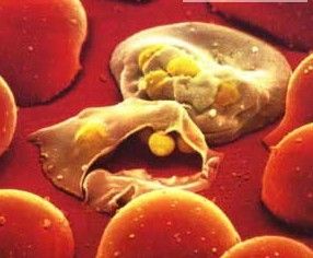 感染瘧疾後人體紅細胞的變化