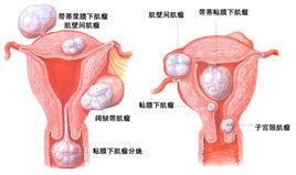 漿膜下子宮肌瘤