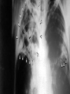 活動性肺結核 活動性肺結核