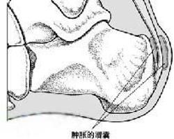 跟腱後滑囊炎 跟腱後滑囊炎