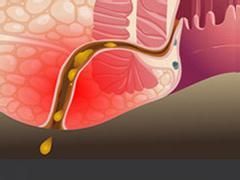 高位肛瘺 高位肛瘺