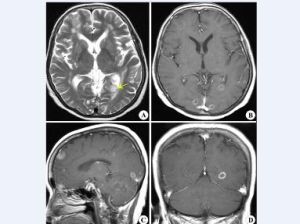 結核性腦膜炎 結核性腦膜炎