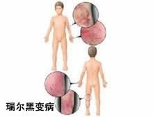 瑞爾黑變病 瑞爾黑變病