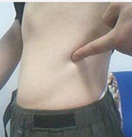 肋間神經炎 肋間神經炎