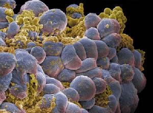 （圖）遺傳性乳腺癌-卵巢癌綜合徵