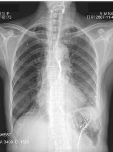 陳舊性肺結核 陳舊性肺結核