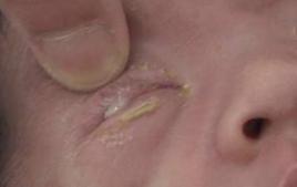 新生兒膿漏眼 新生兒膿漏眼