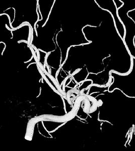 （圖）腦內動脈瘤