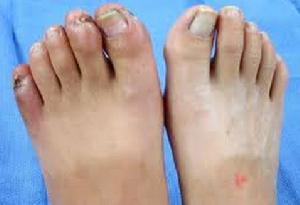 血栓閉塞性關脈炎 血栓閉塞性關脈炎