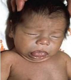 小兒先天性甲狀腺功能減低症 小兒先天性甲狀腺功能減低症