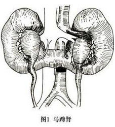 馬蹄腎