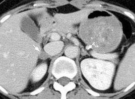 雙側腎上腺皮質增生 雙側腎上腺皮質增生