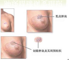 乳腺增生症 乳腺增生症