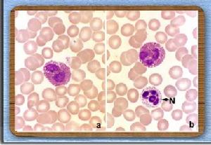 巨乳頭性結膜炎