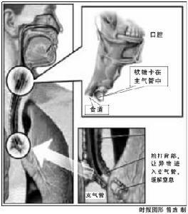 急性缺氧性腦病 急性缺氧性腦病
