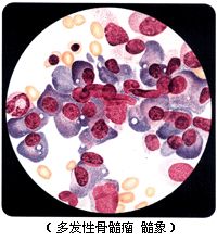 骨髓瘤