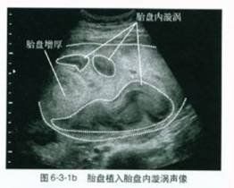 胎盤植入 胎盤植入