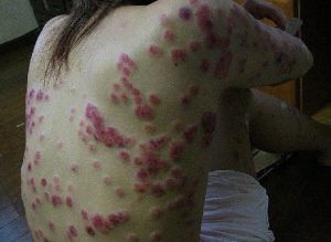 一期梅毒 一期梅毒