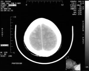 腦血管破裂 腦血管破裂