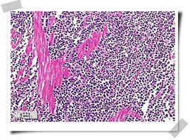 異型淋巴細胞 異型淋巴細胞