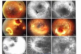視網膜大動脈瘤 視網膜大動脈瘤