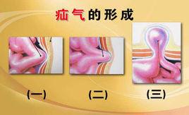 老年疝氣 老年疝氣