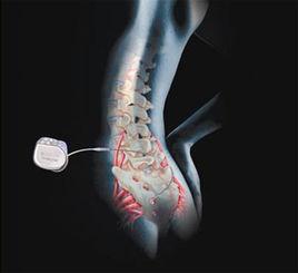 腸道起搏器植入術 腸道起搏器植入術