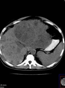 腹腔積液 腹腔積液